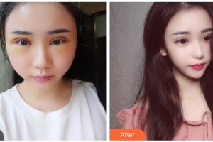 遵義韓美整形美容醫(yī)院汪玉云整形價格表附切開雙眼皮案例展示