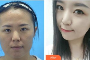 遵義利美康整形美容醫(yī)院邢云鵬整形價格表附隱形托槽矯正案例展示