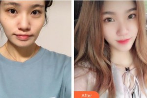 遵義利美康整形美容醫(yī)院何瑾整形價格表附埋線提升案例展示