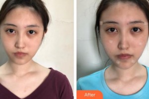 遵義喬雅菲醫(yī)療美容門診部賴炳文整形價格表附埋線提升案例展示