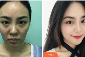 遵義醫(yī)學院附院美容醫(yī)院孫娜娜整形價格表附埋線提升案例展示