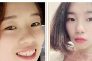 遵義韓美整形美容醫(yī)院李志強整形價格表附牙齒陶瓷矯正案例展示