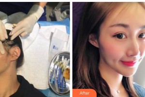 遵義利美康整形美容醫(yī)院龍萍整形價格表附埋線提升案例展示