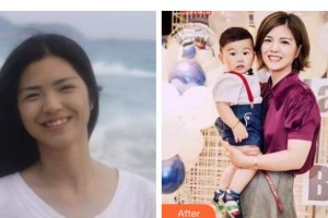 遵義利美康整形美容醫(yī)院陳學會整形價格表附牙齒隱形矯正案例展示