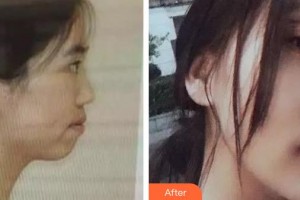 遵義韓美整形美容醫(yī)院樸奎南整形價格表附金屬托槽矯正案例展示