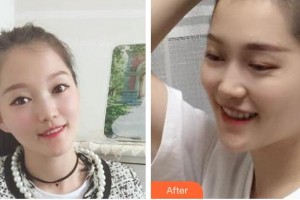 遵義利美康整形美容醫(yī)院曹金喜整形價格表附金屬托槽矯正案例展示