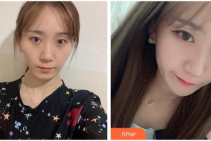 遵義韓美整形美容醫(yī)院安基云整形價格表附顴骨顴弓整形術案例展示