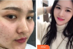 遵義喬雅菲醫(yī)療美容門診部羅碧強整形價格表附紅藍(lán)光祛痘案例展示