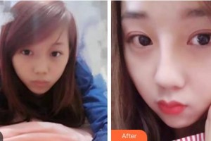 遵義喬雅菲醫(yī)療美容門診部彭于賓整形價(jià)格表附清潔祛痘案例展示