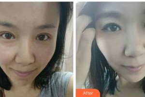 遵義現(xiàn)代皮膚病醫(yī)院陳炳全整形價(jià)格表附紅藍(lán)光祛痘案例展示