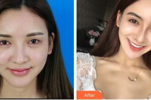 銅仁韓美時光醫(yī)療美容門診部張雪梅整形價格表附切開雙眼皮案例展示