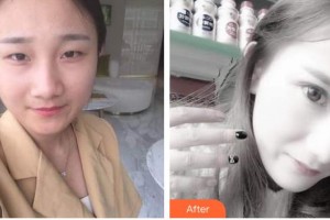 銅仁仁愛眼科醫(yī)院鄧西鐵整形價格表附眼部綜合案例展示