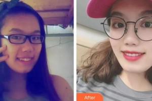 黔西南興義京州口腔醫(yī)院徐勇整形價格表附隱形托槽矯正案例展示