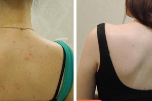 畢節(jié)利美康醫(yī)療美容門診部劉冰語整形價格表附清潔祛痘案例展示