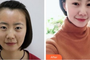 畢節(jié)陽明眼科醫(yī)院梁占瑩整形價格表附切開雙眼皮案例展示