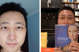 畢節(jié)西南皮膚病醫(yī)院官偉整形價格表附種植眉毛案例展示