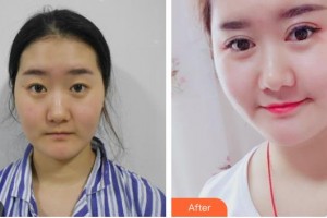 畢節(jié)陽明眼科醫(yī)院郝建整形價格表附眼部綜合案例展示