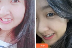 武警青?？傟犪t(yī)院美容整形中心鄒邦新整形價格表附金屬托槽矯正案例展示