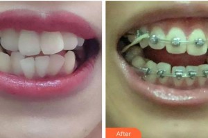 青海康華整形醫(yī)院時林月整形價格表附金屬托槽矯正案例展示