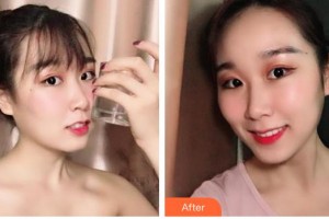 青海紅十字醫(yī)院整形美容科秦志彤整形價格表附牙齒隱形矯正案例展示