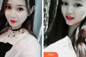 青海省人民醫(yī)院頜面整形外科周泉整形價格表附牙齒隱形矯正案例展示