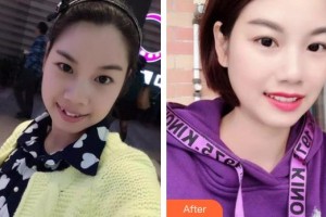 青海省人民醫(yī)院頜面整形外科趙琳整形價格表附金屬托槽矯正案例展示