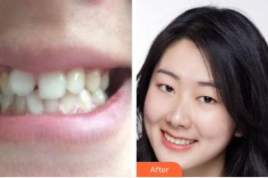 青海省人民醫(yī)院頜面整形外科劉世杰整形價格表附牙齒陶瓷矯正案例展示