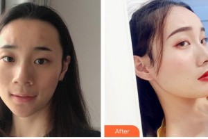 青海米瀾之星整形美容醫(yī)院張光武整形價格表附鼻部綜合案例展示