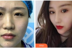 青?？等A整形醫(yī)院馮相周整形價格表附耳軟骨復合隆鼻案例展示