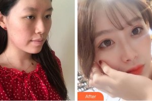 青海紅十字醫(yī)院整形美容科李桂梅整形價格表附自體軟骨墊鼻尖案例展示