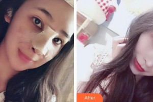 青海康華整形醫(yī)院馬晶整形價格表附鼻部綜合案例展示