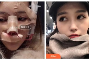 青?？等A整形醫(yī)院蔡志昆整形價格表附鼻部綜合案例展示