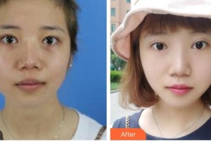 青海康華整形醫(yī)院宋羽整形價格表附激光祛斑案例展示