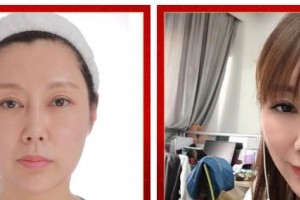 廣西醫(yī)科大學(xué)美容整形中心黎凍整形價格表附埋線提升案例展示