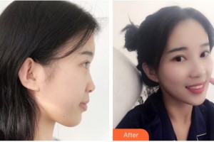 廣西東方整形美容醫(yī)院仇侃敏整形價格表附鼻部綜合案例展示