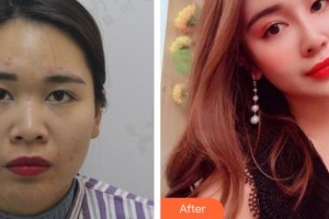 廣西醫(yī)科大學(xué)美容整形中心周翔整形價格表附耳軟骨復(fù)合隆鼻案例展示