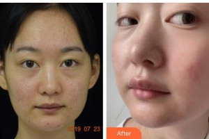 廣西醫(yī)科大學(xué)美容整形中心韋潔整形價格表附去痘印痘坑案例展示