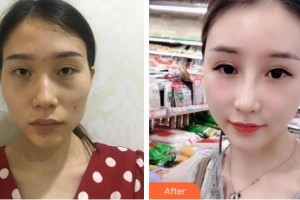 廣西愛思特整形外科醫(yī)院李俊明整形價格表附鼻部綜合案例展示