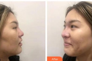 廣西壯族自治區(qū)人民醫(yī)院整形美容中心麥慧整形價格表附鼻部綜合案例展示