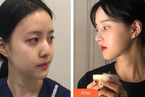 廣西壯族自治區(qū)人民醫(yī)院整形美容中心黃欣整形價格表附鼻部綜合案例展示