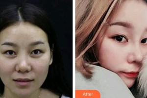 武警廣西總隊醫(yī)院醫(yī)學(xué)整形美容中心孫周映整形價格表附鼻部綜合案例展示