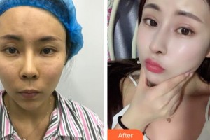 武警廣西總隊醫(yī)院醫(yī)學(xué)整形美容中心陳笑整形價格表附鼻修復(fù)案例展示