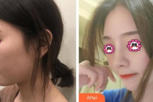 武警廣西總隊醫(yī)院醫(yī)學(xué)整形美容中心尹熙根整形價格表附肋軟骨隆鼻案例展示