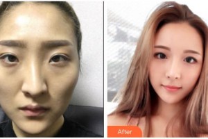 武警廣西總隊醫(yī)院醫(yī)學(xué)整形美容中心樸宰久整形價格表附假體隆鼻案例展示