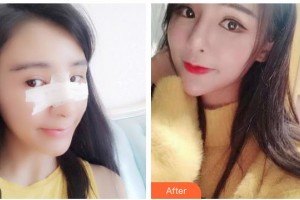 武警廣西總隊醫(yī)院醫(yī)學(xué)整形美容中心玉寶光 整形價格表附耳軟骨復(fù)合隆鼻案例展示