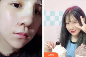 廣西民族醫(yī)院醫(yī)學(xué)美容科楊竟忠整形價格表附鼻部綜合案例展示