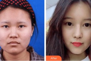 廣西中醫(yī)院第一附屬醫(yī)院美膚激光整形美容科李紅陽整形價格表附鼻部綜合案例展示