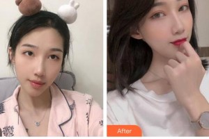 廣西東方整形美容醫(yī)院程健整形價格表附鼻部綜合案例展示