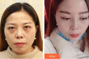 武警廣西總隊醫(yī)院醫(yī)學(xué)整形美容中心李奎昊整形價格表附鼻部綜合案例展示