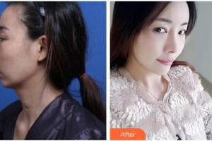 廣西醫(yī)科大學(xué)第一附屬醫(yī)院整形美容科黃安林整形價格表附鼻修復(fù)案例展示